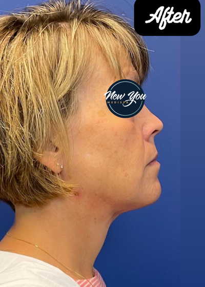 After Neck Liposuction Vaser LipoContouring Abdominoplasty AFTER.jpg