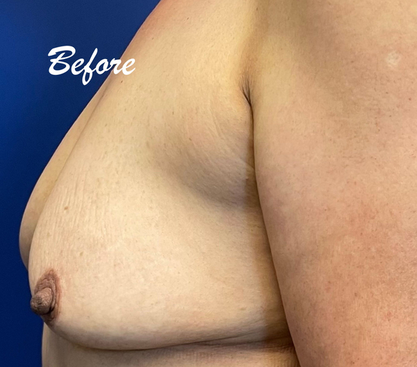 breast lift before