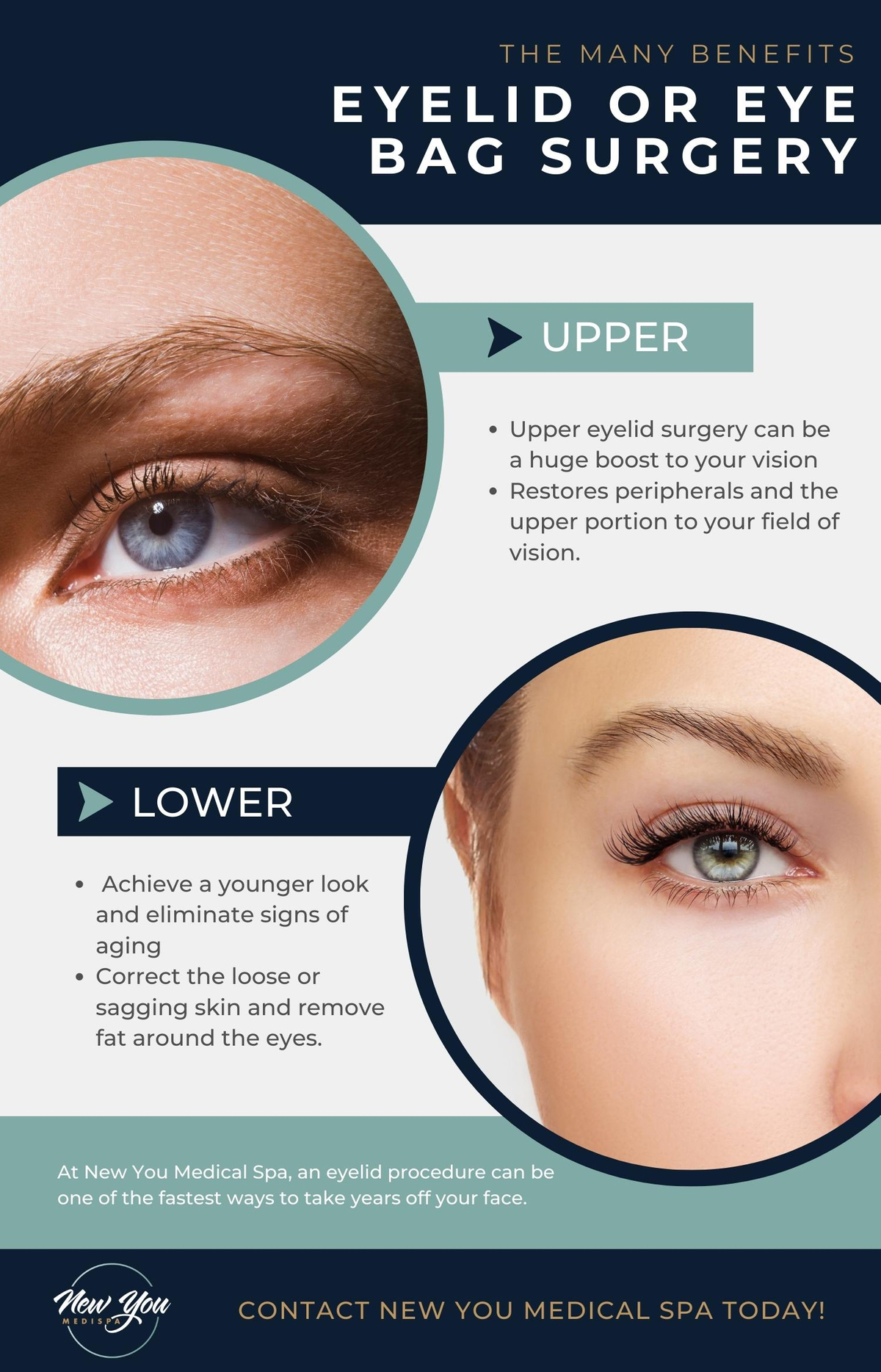 Eyelid Surgery Infographic