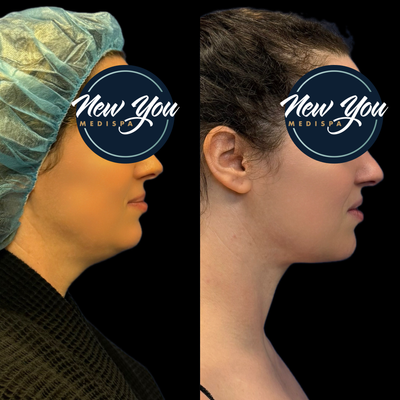 Before and After Neck Lipo Suction