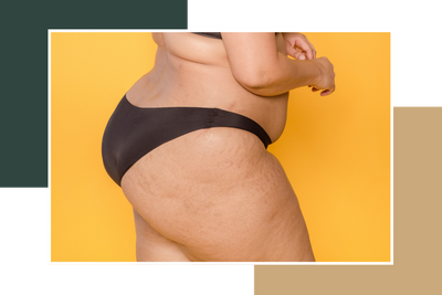 cellulite.png