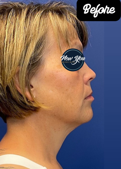 Before Neck Liposuction.jpg