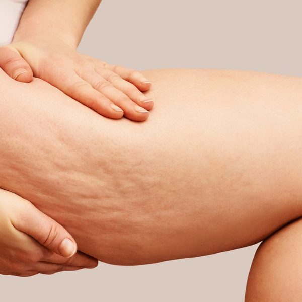 woman's leg with cellulite