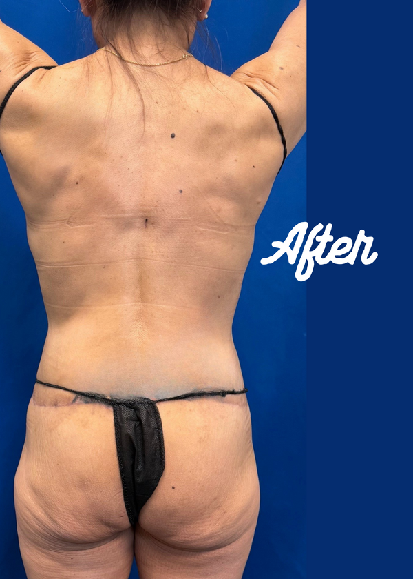 GlutealLift with Vaser Lipocontouring Before & After (1).png