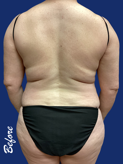 img of a woman before liposuction Before.jpg