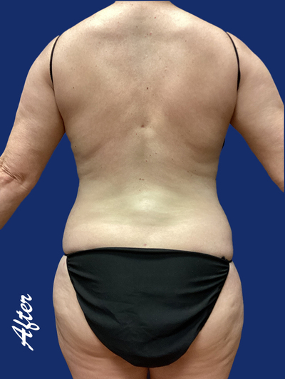 img of a woman after liposuction After.jpg