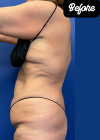 180 Vaser LipoContouring Abdominoplasty BEFORE 2.png