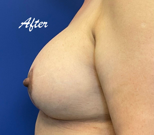 breast lift before