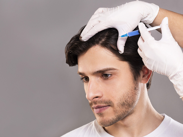 A man receiving PRP treatment for his hair