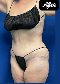 180 Vaser LipoContouring Abdominoplasty AFTER.png