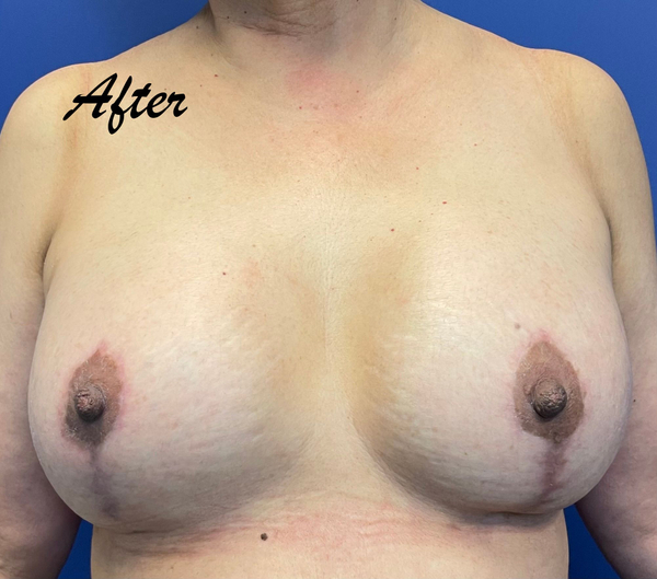 breast lift after