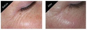 gallery_wrinkle_treatment_02-161216-58542901a23c1._close.png