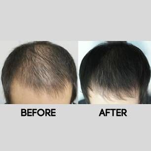 hair-growth-thumb-2-161216-58542a6cdc148.jpg