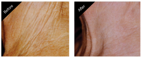 gallery_skin_rejuvenation_treatment_02-161216-585428f120220._close.png