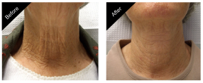 gallery_skin_tightening_treatment_01-161216-5854290ee2a88._close.png