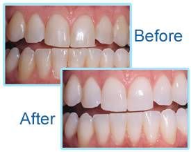 whitening-161216-585436a73a783.jpg