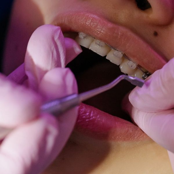 metal braces4.jpg