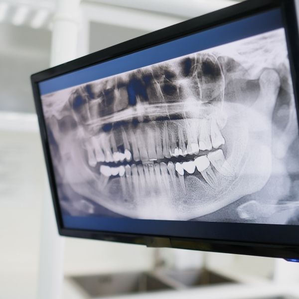 Tooth x-rays.