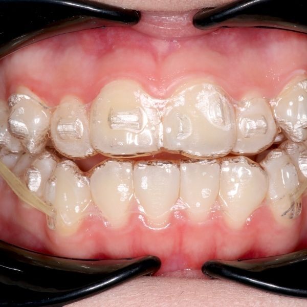 Clear aligners. Clear aligners.