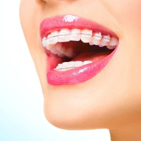 clear braces1.jpg