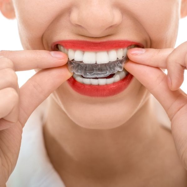 aligners.jpg