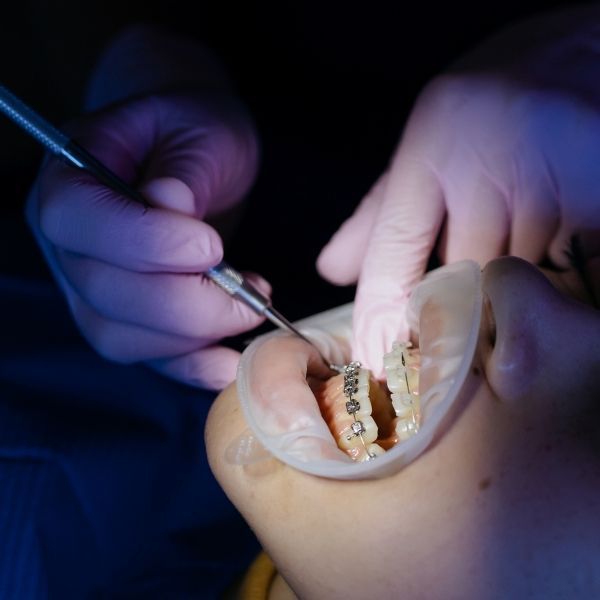 A patient wearing braces.