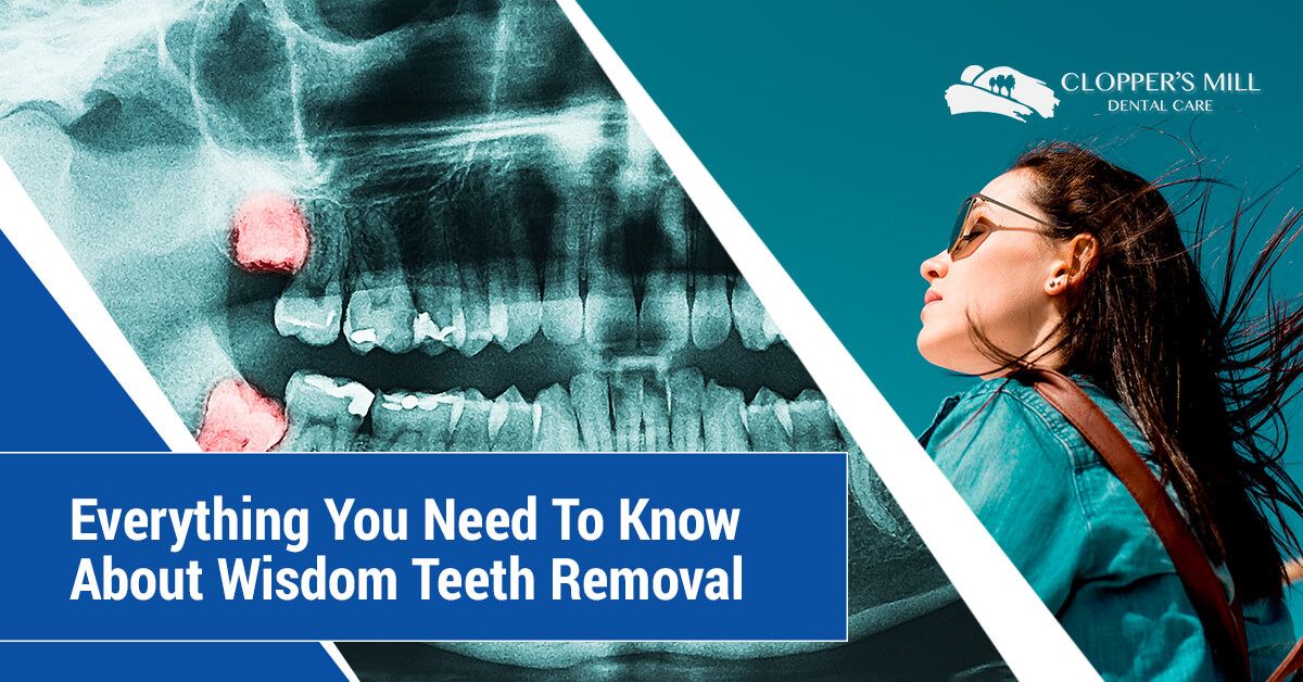 Blog-Everything-You-Need-To-Know-About-Wisdom-Teeth-Removal-5b3255ede8cb1.jpg