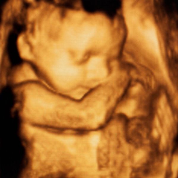 4D ultrasound