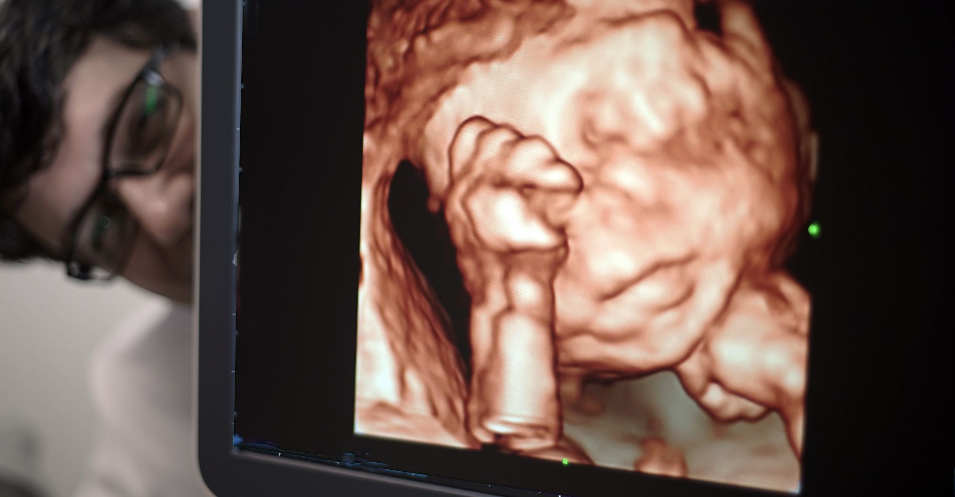 3D ultrasound on monitor