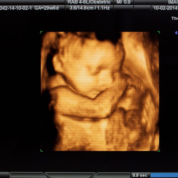 a 3D ultrasound image of a baby