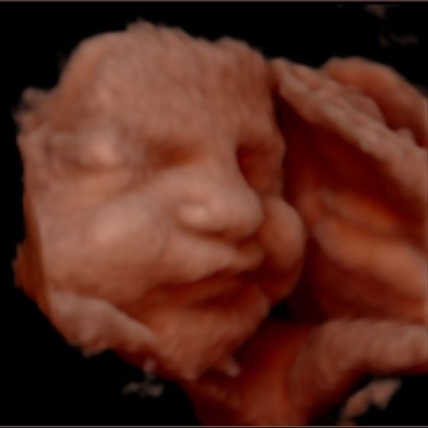 3D ultrasound image