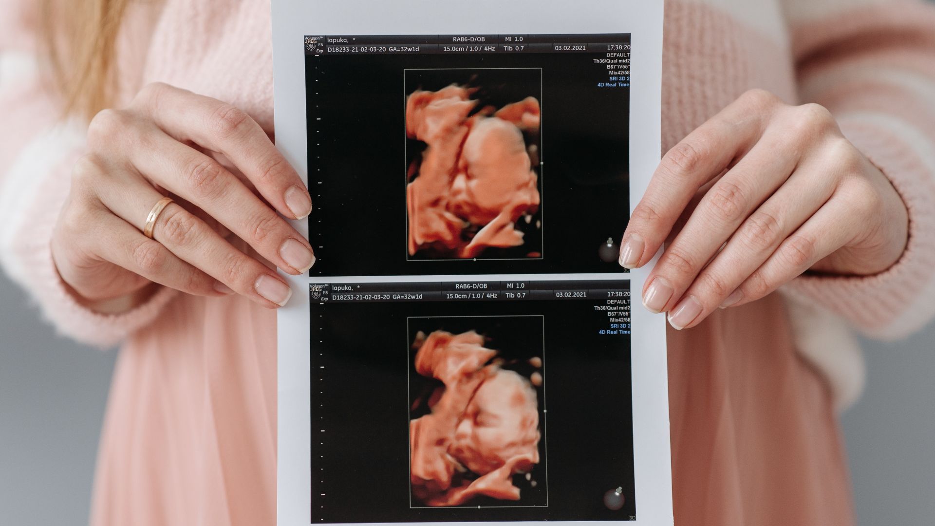 3d ultrasound