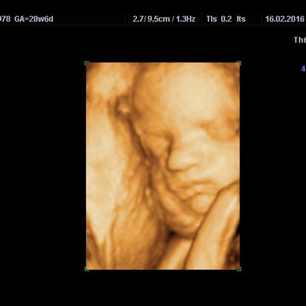 image2 -  Benefits of 3D Ultrasounds for Parents-to-Be.jpg