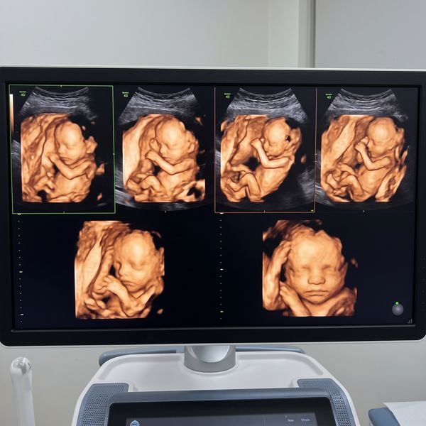 The Magic of Seeing Your Baby in 3D and 4D Ultrasounds-Image3.jpeg