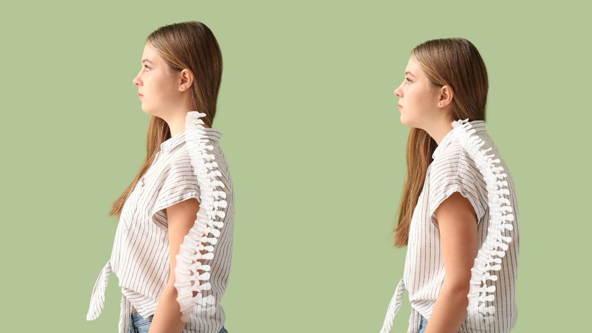 Spinal comparison of women with good versus bad posture