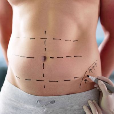 drawing on belly for liposuction