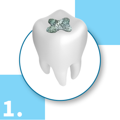 Amalgam Fillings