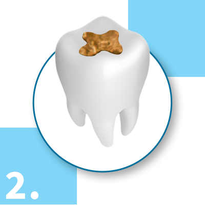 Cast Gold Fillings