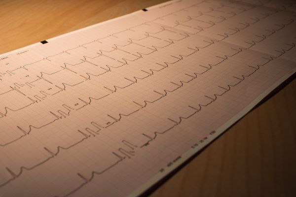 EKG