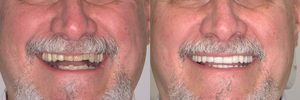 Restoring-chipped-and-worn-out-teeth-with-Dental-Crowns-1536x512.png
