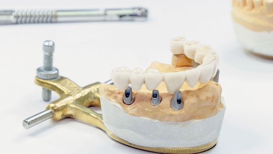 mold of dental implants