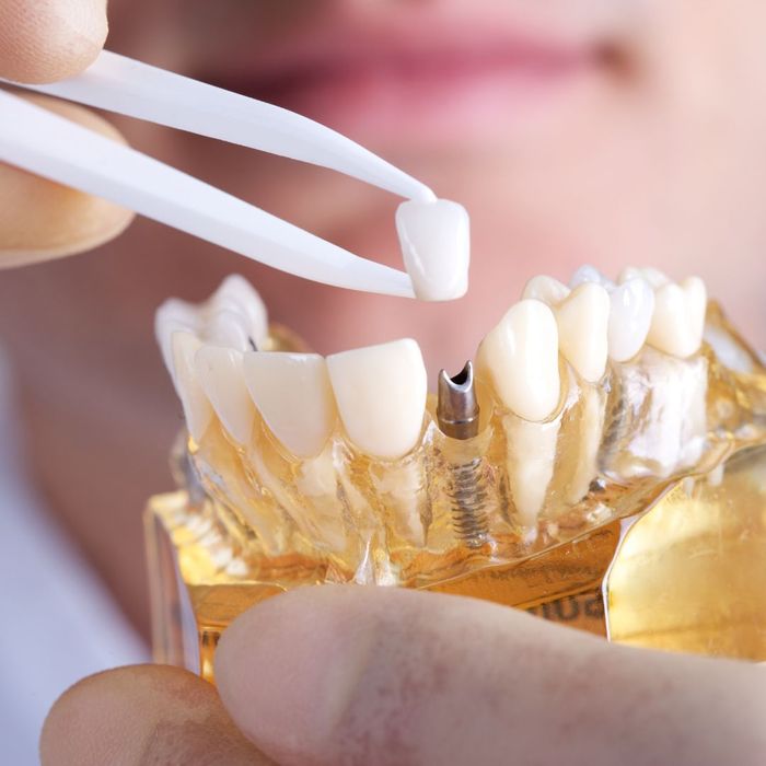 person examining dental implant