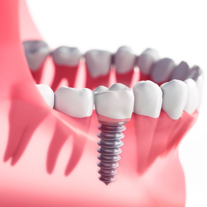 What is the Difference Between Crowns, Bridges, and Implants_ 3.jpg