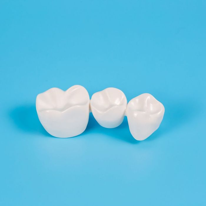 What is the Difference Between Crowns, Bridges, and Implants_ 1.jpg