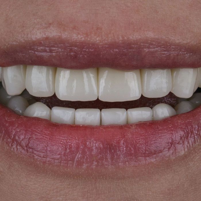 M37203 - Blog - How Veneers Improve Your Smile - Image 4.jpg