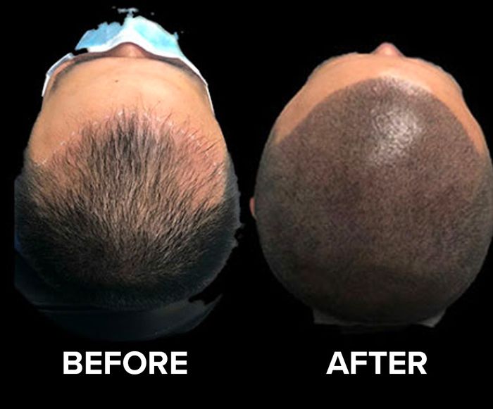 Before/after image of a man who received scalp micro pigmentation for thinning hair