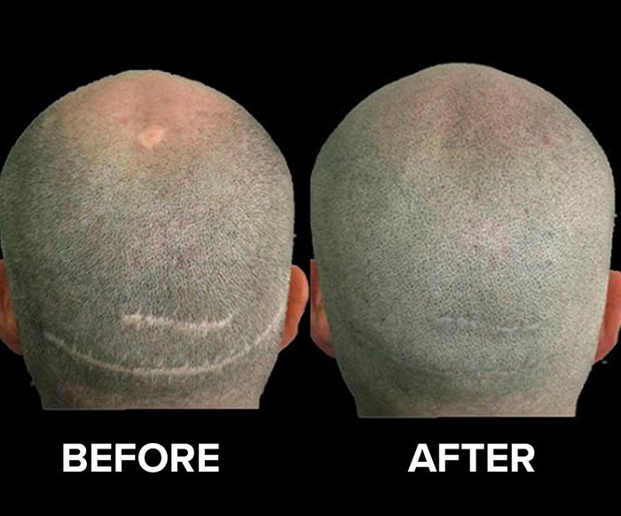 Before/after image of a man who received scalp micro pigmentation for scarring