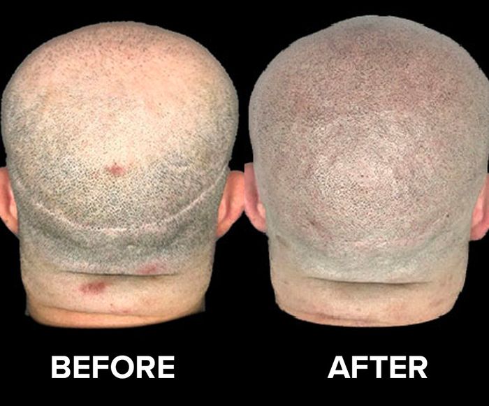 Before/After image of a man who received scalp micro pigmentation for hair transplant scars