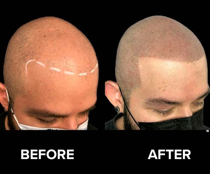 Before/after image of a man who received scalp micro pigmentation for pattern baldness