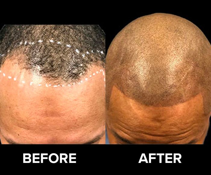 Before/after image of a man who received scalp micro pigmentation for hairline restoration